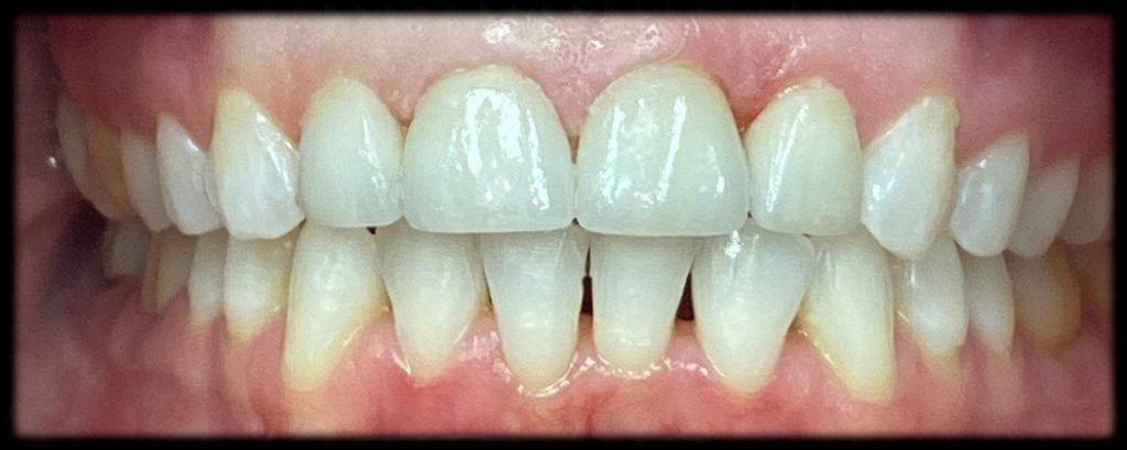 Case 1 After